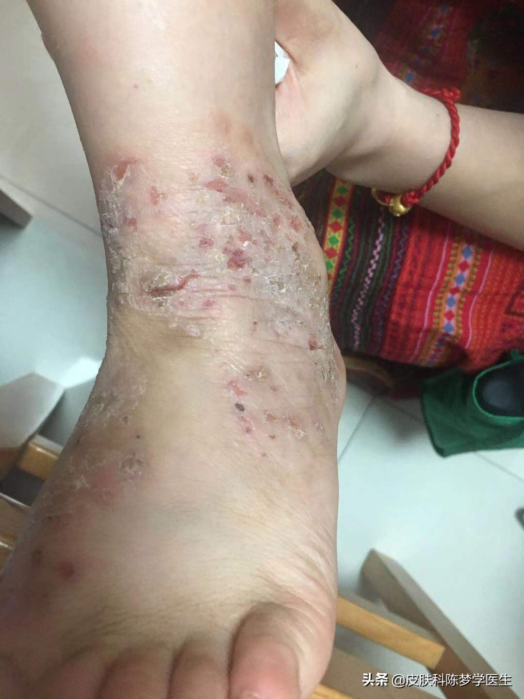 湿疹好治吗(湿疹可以彻底治愈吗)