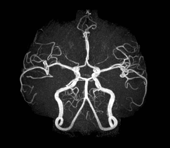 ct,核磁共振,脑血管造影,哪一个才是检查颅内动脉瘤的利器呢?