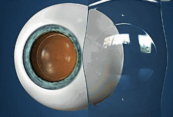 近视患者的福音—ICL晶体植入，作用原理，优缺点，一次性讲清楚