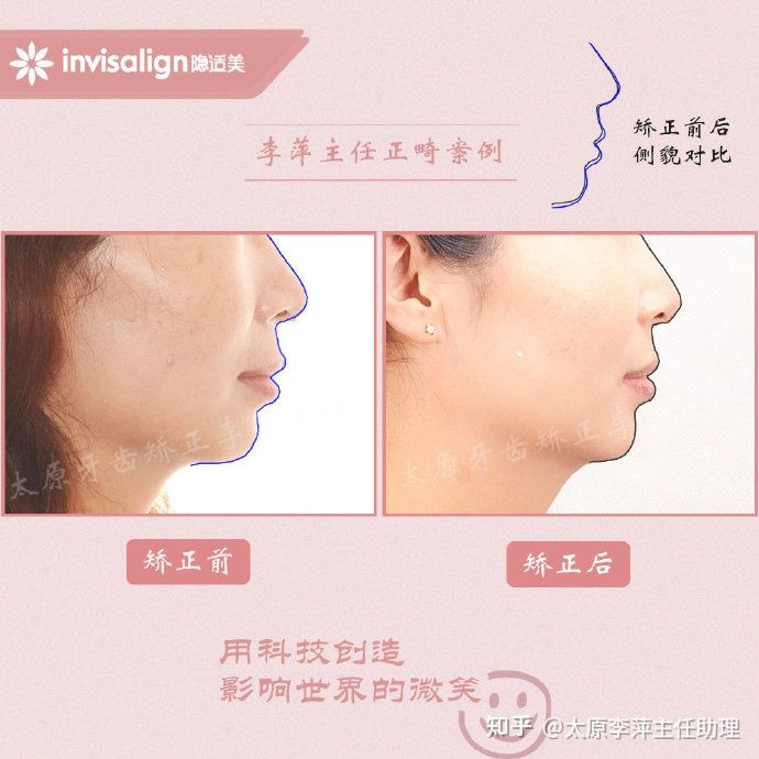 太原牙齿矫正：隐形牙套效果好不好？看这些病例你就知道了