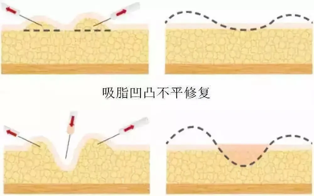 想要轻松享“瘦”就抽脂?抽脂前,一定要清楚这5个问题