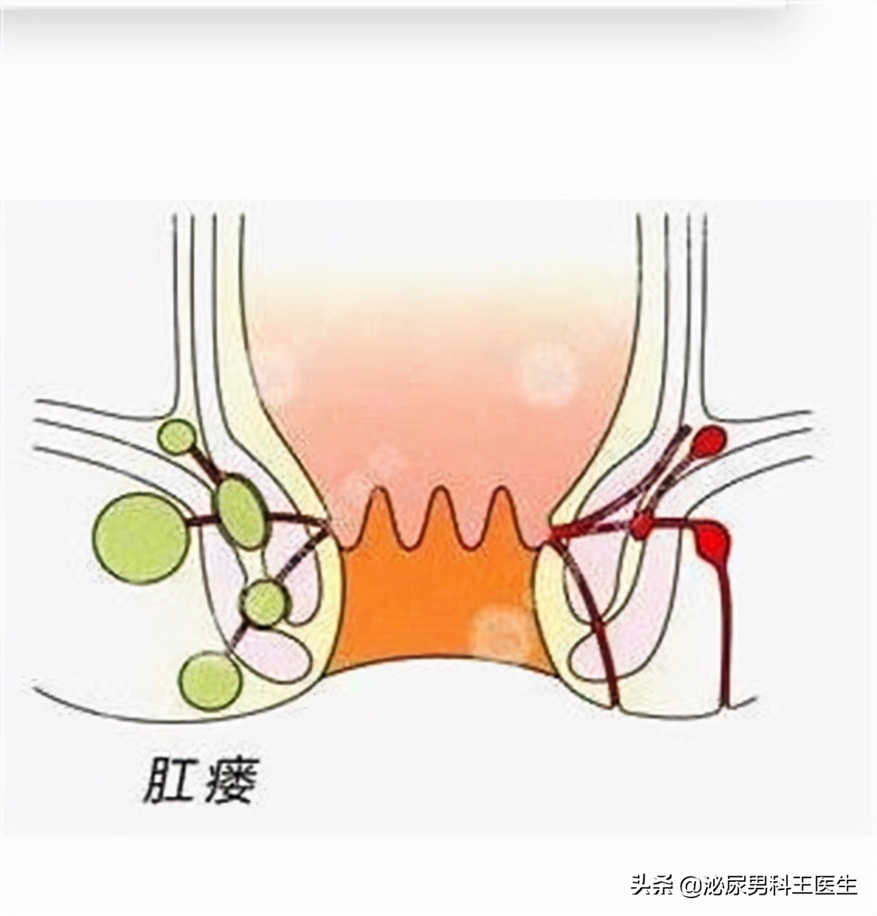 肛瘘患者：“不想治了，我真的太痛了！”肛瘘手术到底有多痛？