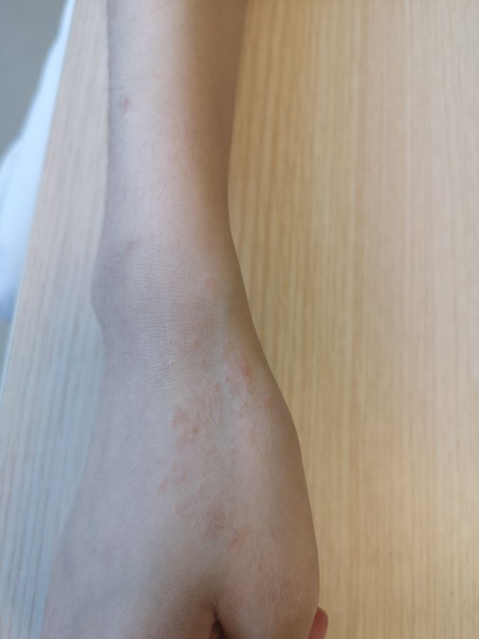 扁平苔藓是什么病图片(长成一条线的就是线状苔癣) - 赤虎壹号