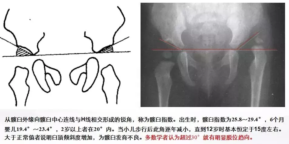 發育性髖關節脫位致殘率高,該如何早期發現呢?