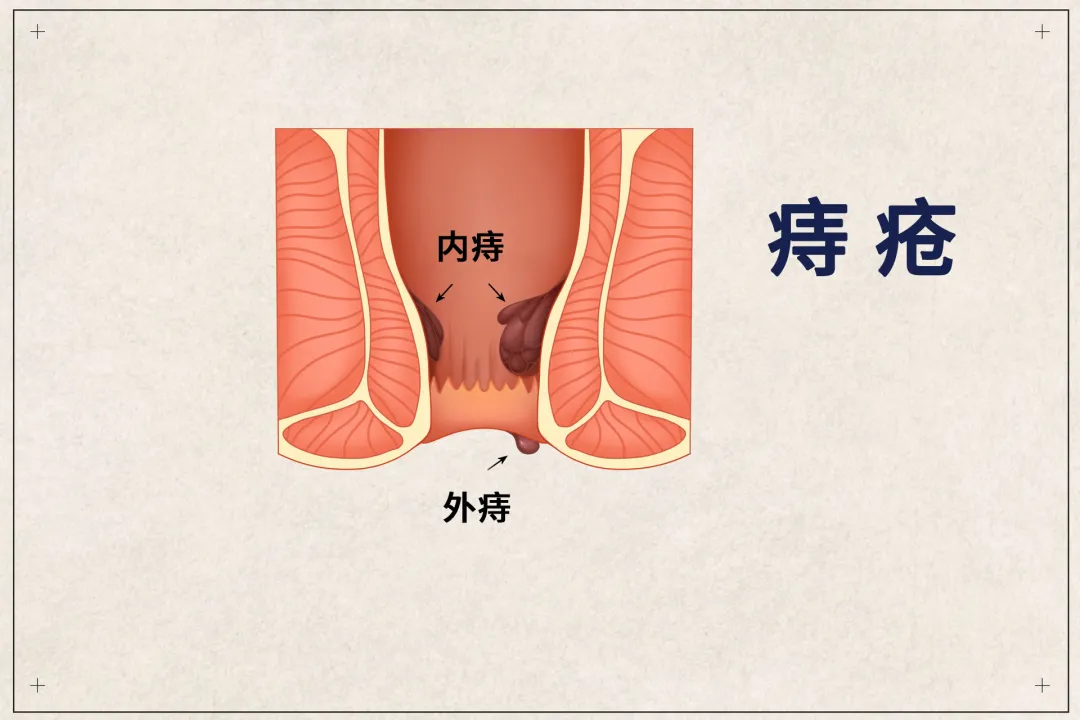 痔疮手术哪种最彻底？哪种最不疼？一文告诉你常见痔疮手术优缺点