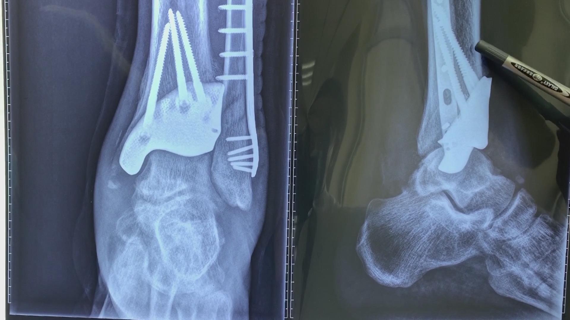 崴脚骨折7个月不治疗,结果骨头碎成20多块