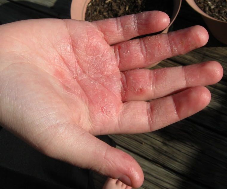 10个妈妈9个手部有"主妇手",手部湿疹怎么治