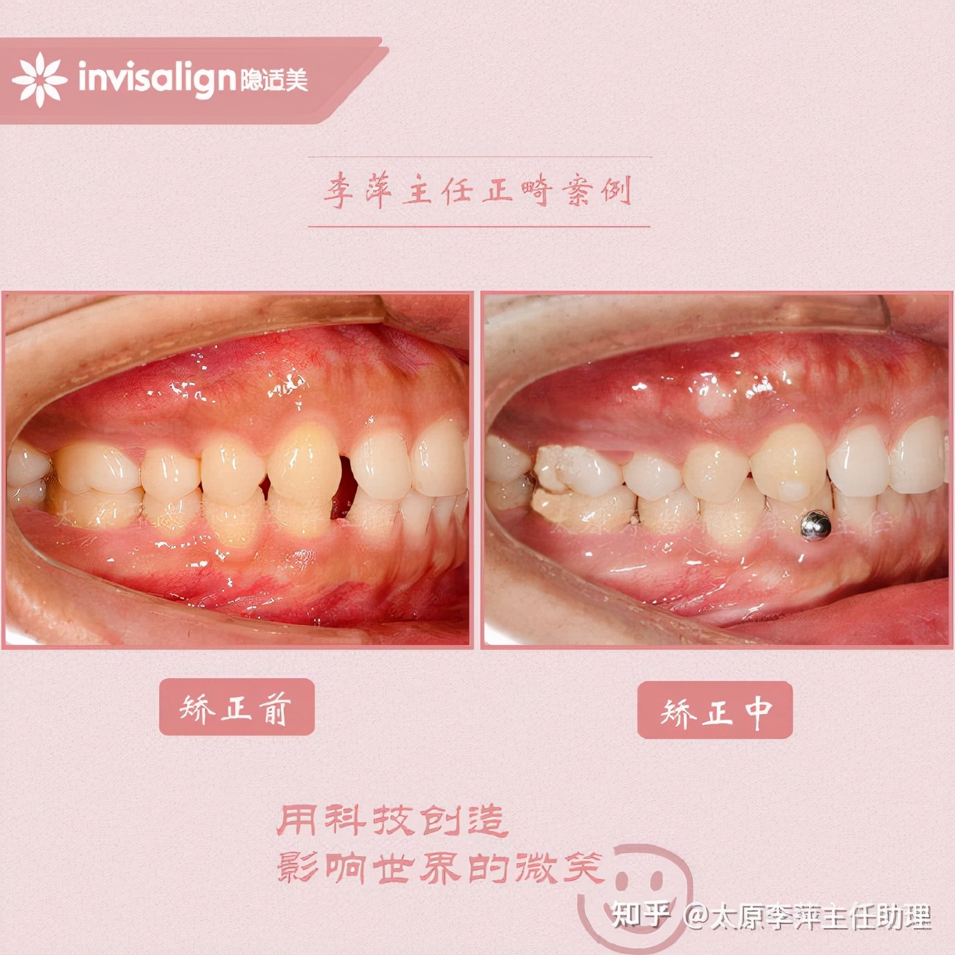 太原牙齿矫正：隐形牙套效果好不好？看这些病例你就知道了