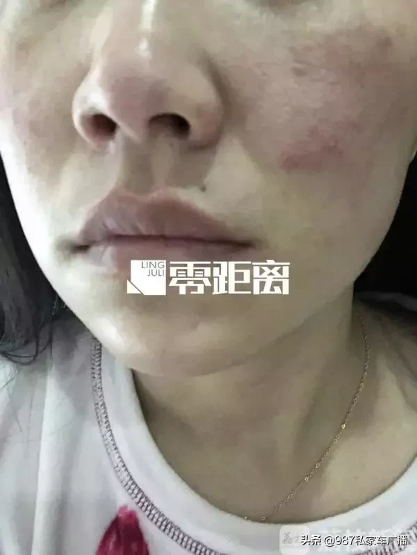 坑！福州徐小姐花1万7做美容，结果脸僵了....