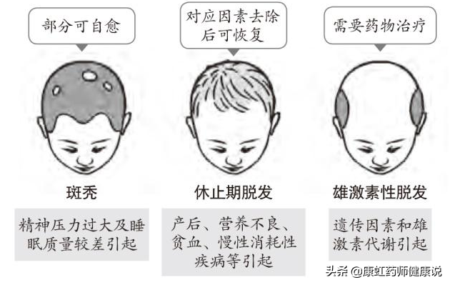 年纪轻轻，怎么就秃了？脱发究竟能不能治好？一文为你讲清楚