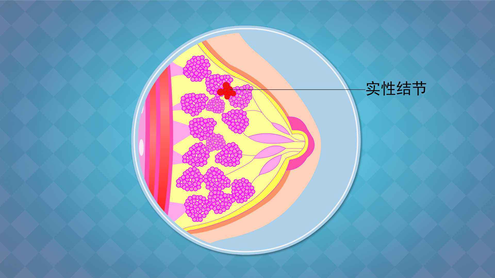 胸部彩超多少钱做一次(体检发现乳房结节很担心)