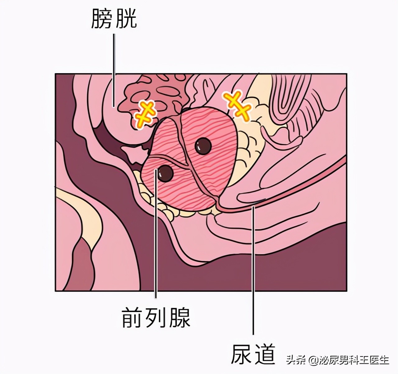 中老年人得了前列腺增生应该怎么办？