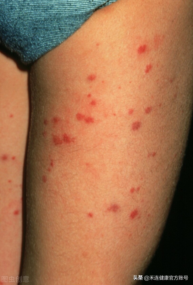 身上有这种小红点,当心肝出了大问题!快查