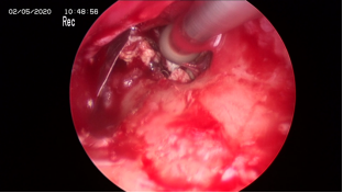 成功拆除患者耳内“定时炸弹”—首例耳内镜下中耳胆脂瘤切除术