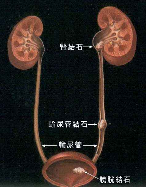 有一种病平时不疼，发作的时候比生孩子还疼，好发于年轻男性