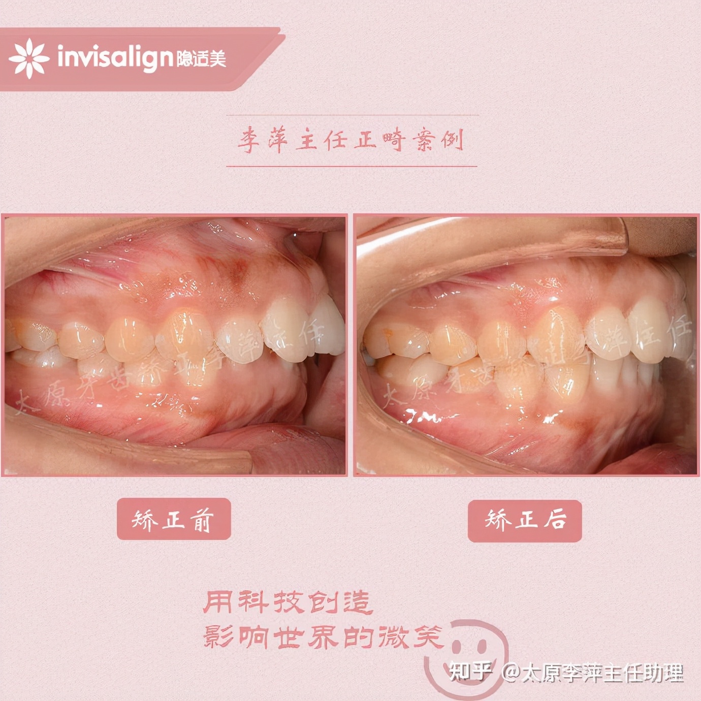 太原牙齿矫正：隐形牙套效果好不好？看这些病例你就知道了