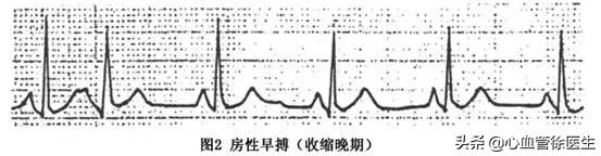 心脏早搏是怎么回事儿？严重吗？有哪些原因和治疗方法？