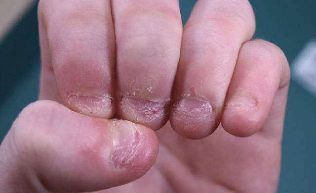 孩子咬指甲会有什么样的危害?