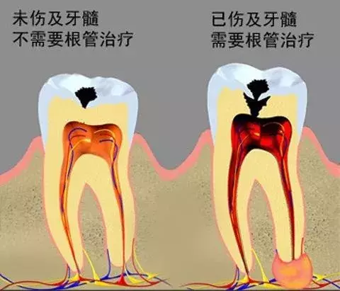 几十块钱就能补好的牙，久拖不治，以至要花上万，冤不冤？