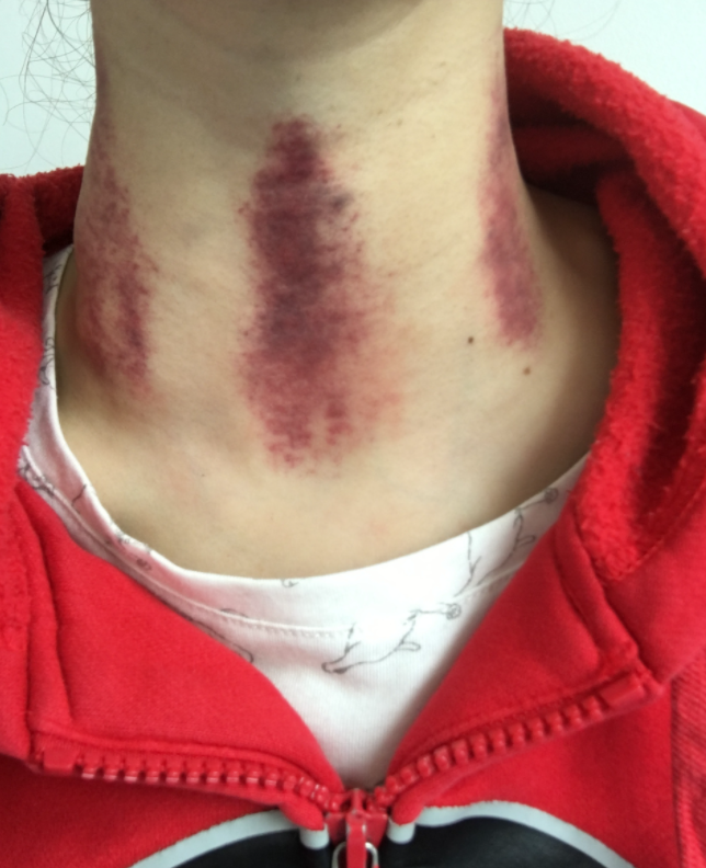 徐婷：全身溃烂医院离世，被8口家人吸血数年，死后姐姐蹭热度？