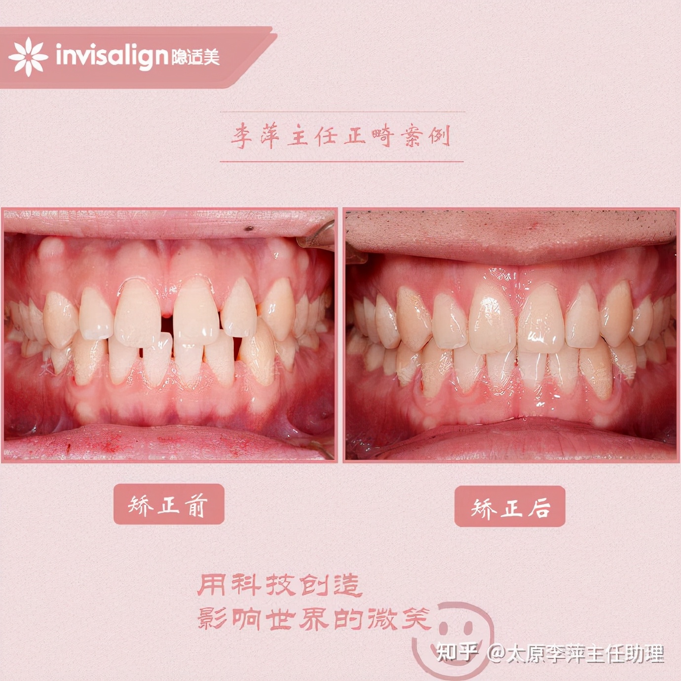 太原牙齿矫正：隐形牙套效果好不好？看这些病例你就知道了