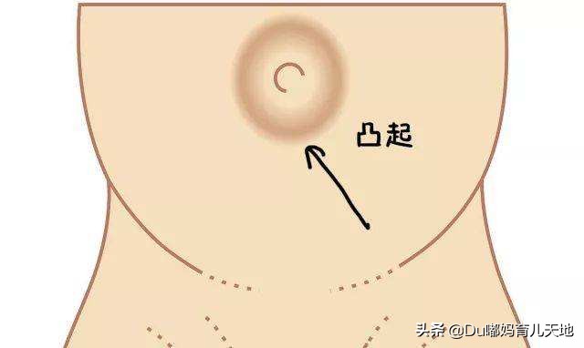 婴儿脐疝应该怎么办？