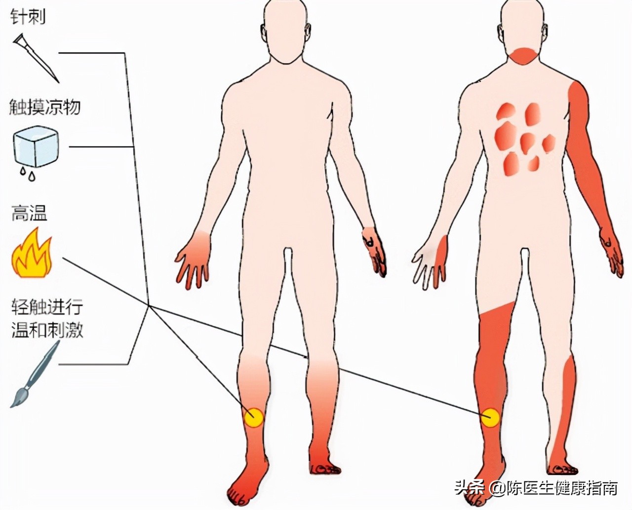 甲钴胺可以修复受损神经，能够用于这几种常见病的治疗，好用