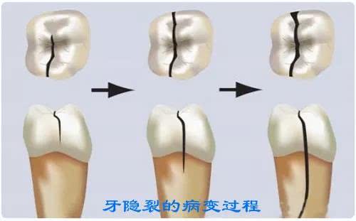 2,龋齿造成的牙齿断裂