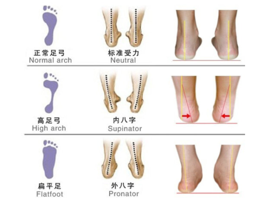 人到中年，足弓就渐渐“塌”了！一个脚印看出足弓高低