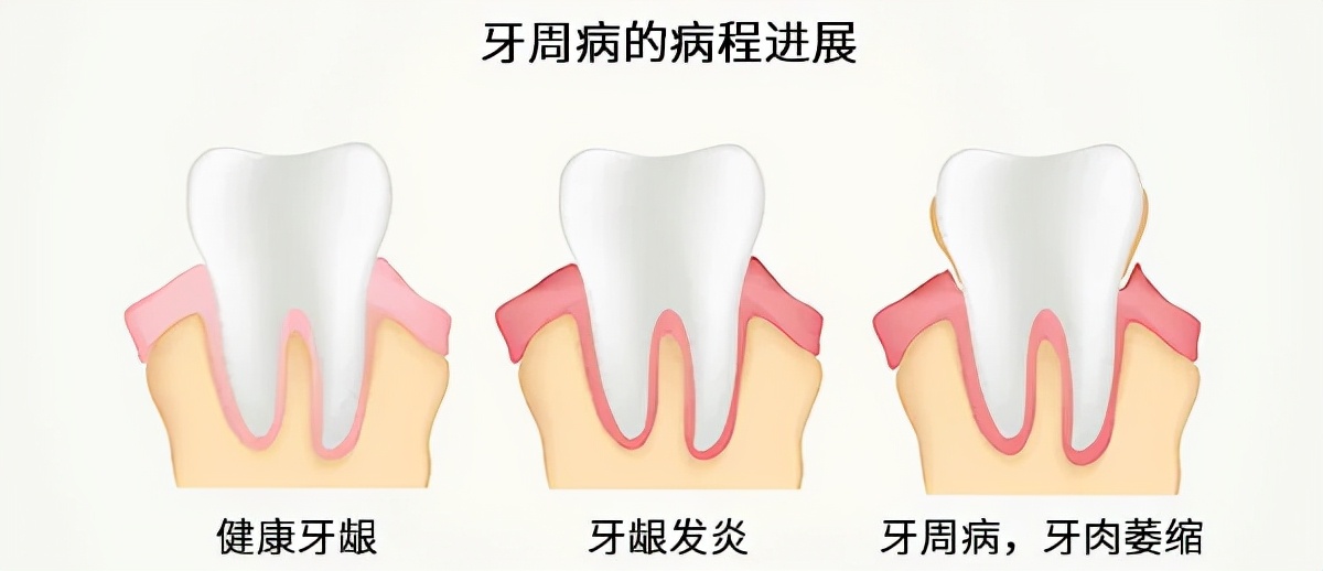 刷牙总出血，很可能是牙齿在喊救命