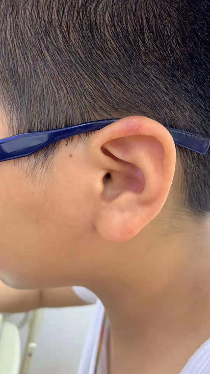 你知道吗？细菌性腮腺炎，还可以这么治