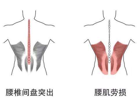 能治疗腰肌劳损的中成药大全