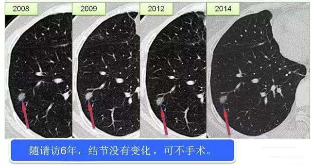 10个人就有2个被发现肺结节，怎么办？切不切？专家教您分辨