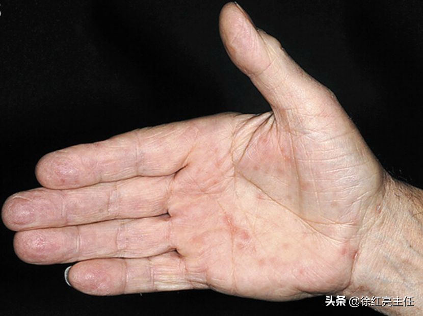 手心脚心全是红疹!检查结果梅毒1:8吓傻全家