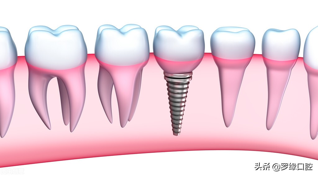 公布上海种植牙价格表，种植牙多少钱一颗，看看吧