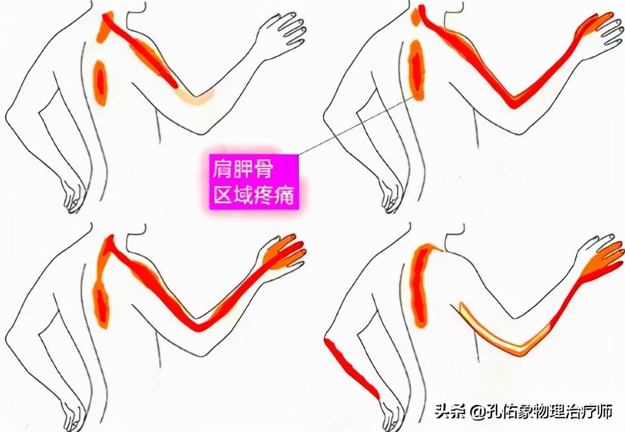 常手麻、手痛，究竟是哪里的问题？不出意外，这5种可能性最大
