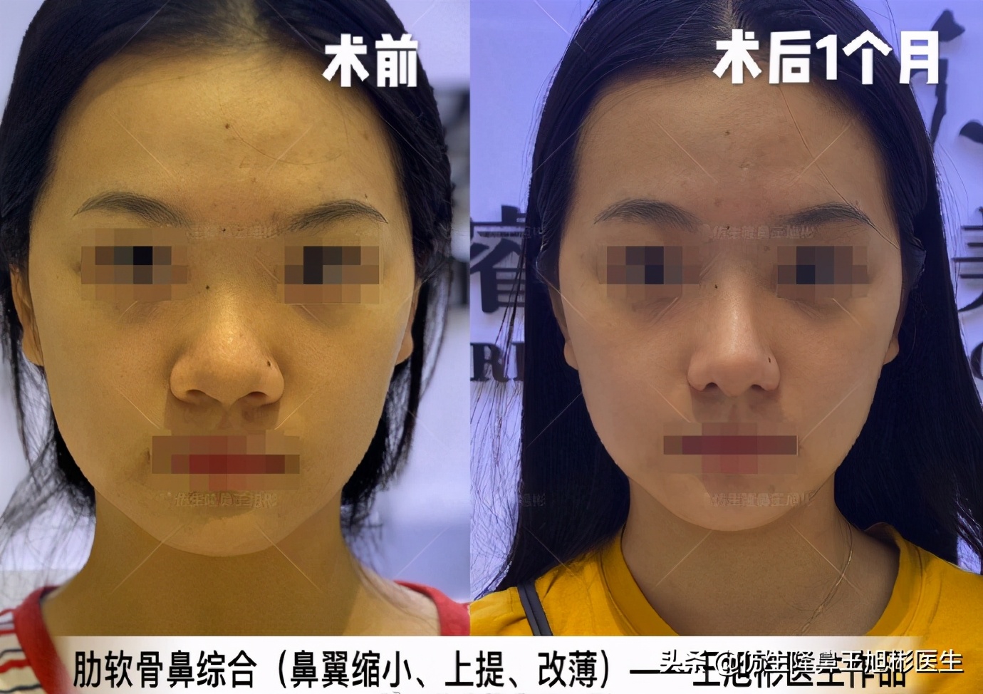 整形鼻头修复视频_整形鼻头修复要多少钱_鼻头修复整形