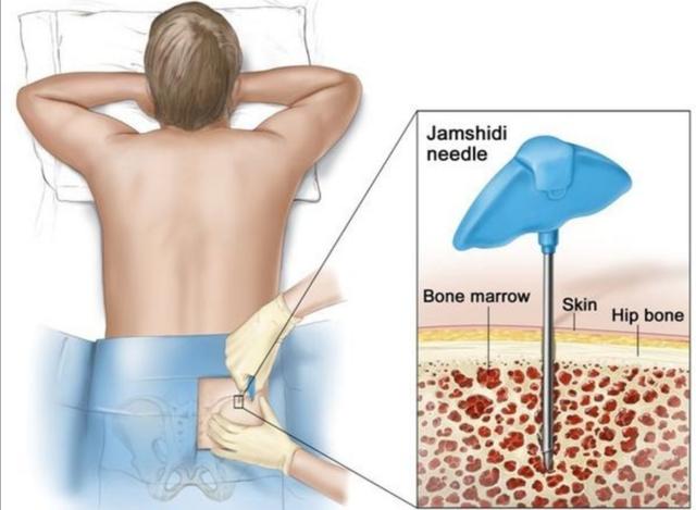 骨穿疼不疼？骨髓穿刺，是否是刮骨疗毒
