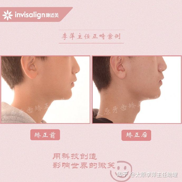 太原牙齿矫正：隐形牙套效果好不好？看这些病例你就知道了