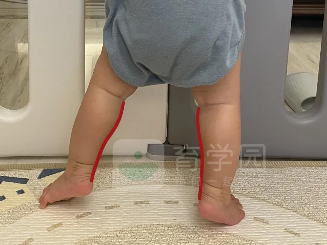 宝宝O型腿、X型腿和过早站有关？如何辨别、矫正？一篇讲明白