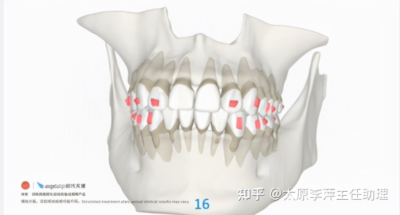 太原牙齿矫正：隐形牙套效果好不好？看这些病例你就知道了