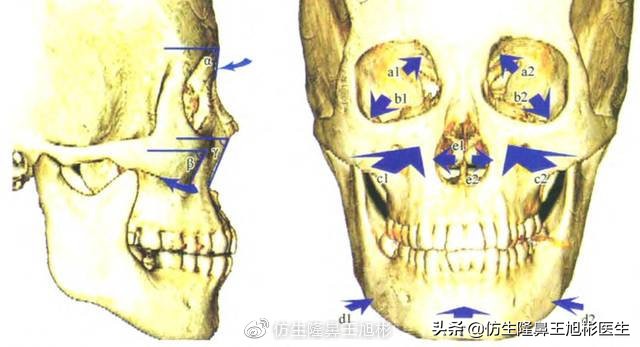 做鼻基底填充就能消灭法令纹？没你想得那么简单