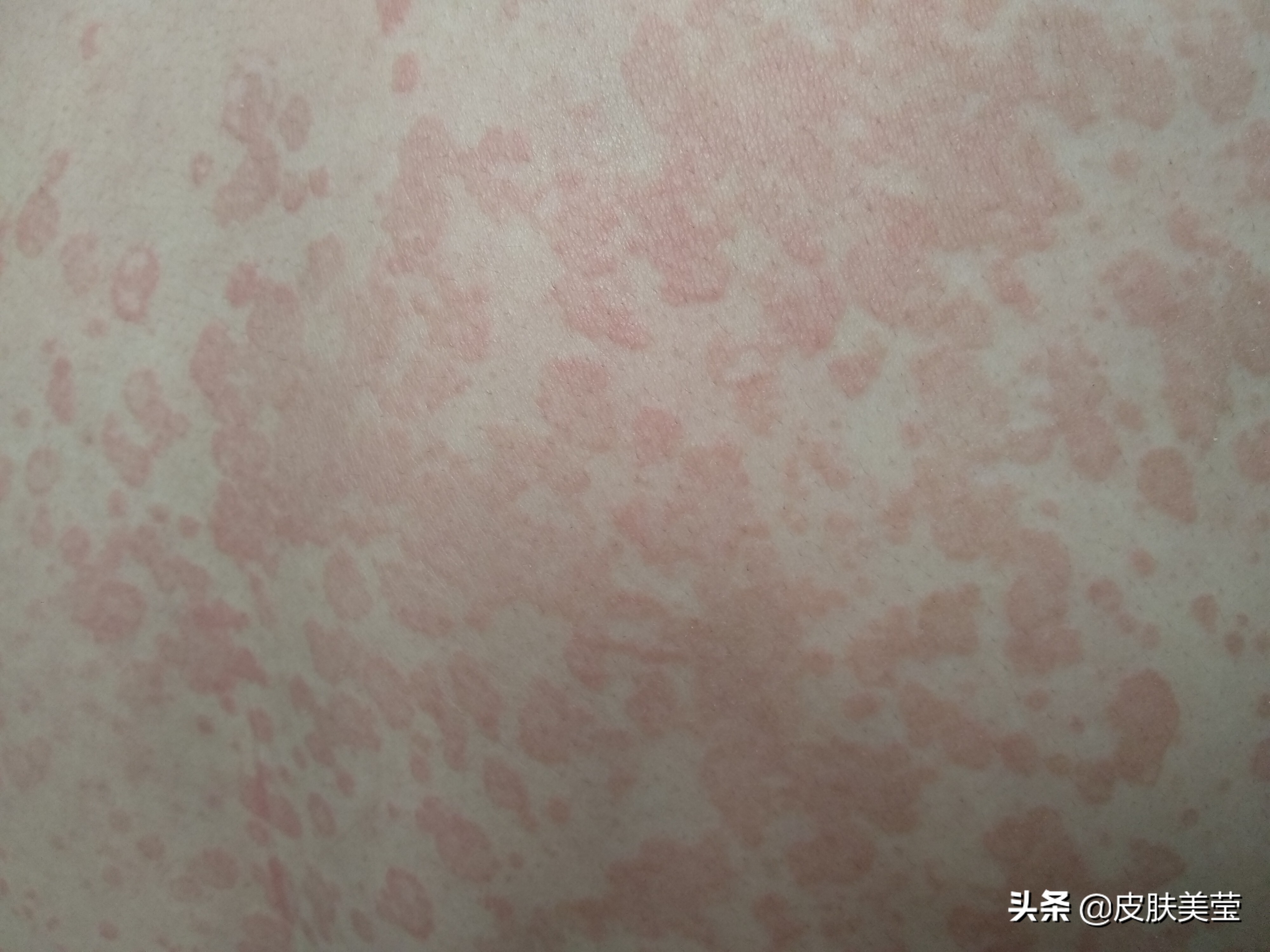 皮膚科 | 小心汗斑近你身 | 鄭惠文醫師Dr.ViVi | 安瑟美皮膚科
