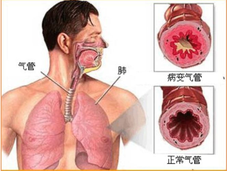 慢性支气管炎导致气喘、活动受限，可怎么办？医生：别慌！这样做
