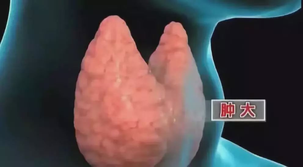 桥本氏甲状腺炎，能治愈吗？会不会癌变？你想知道的都在这