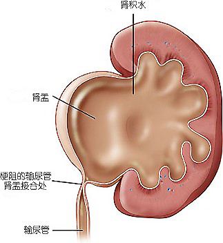 新生儿肾积水，手术也要分情况？医生：出现这些症状快送医！