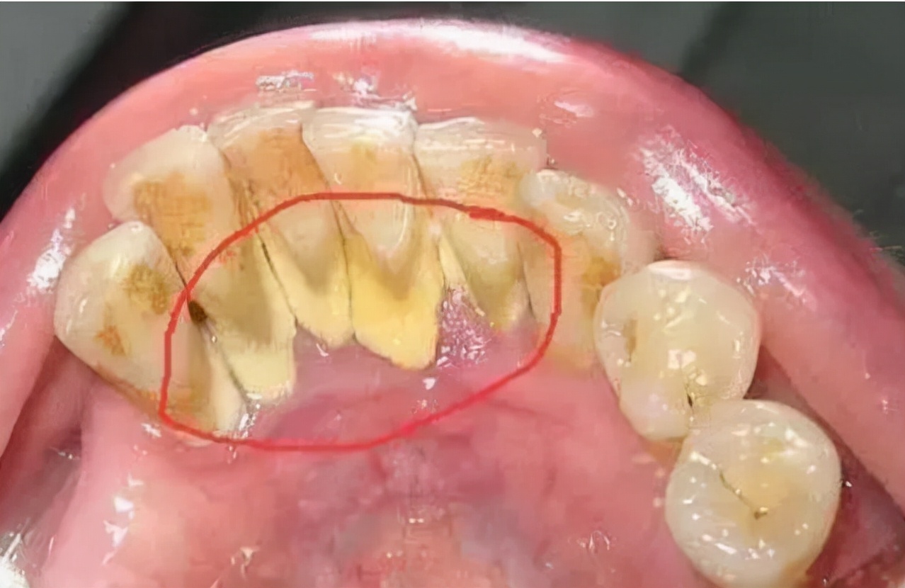 牙结石清理多少钱牙结石