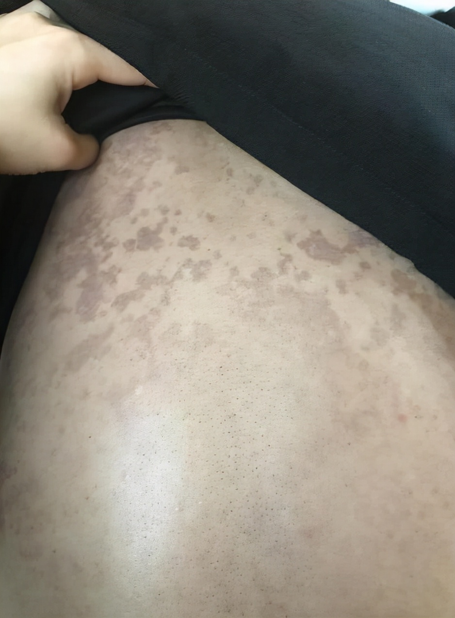 别错把"艾滋"当成皮肤病,身体如果出现5种症状,尽量不要忽视