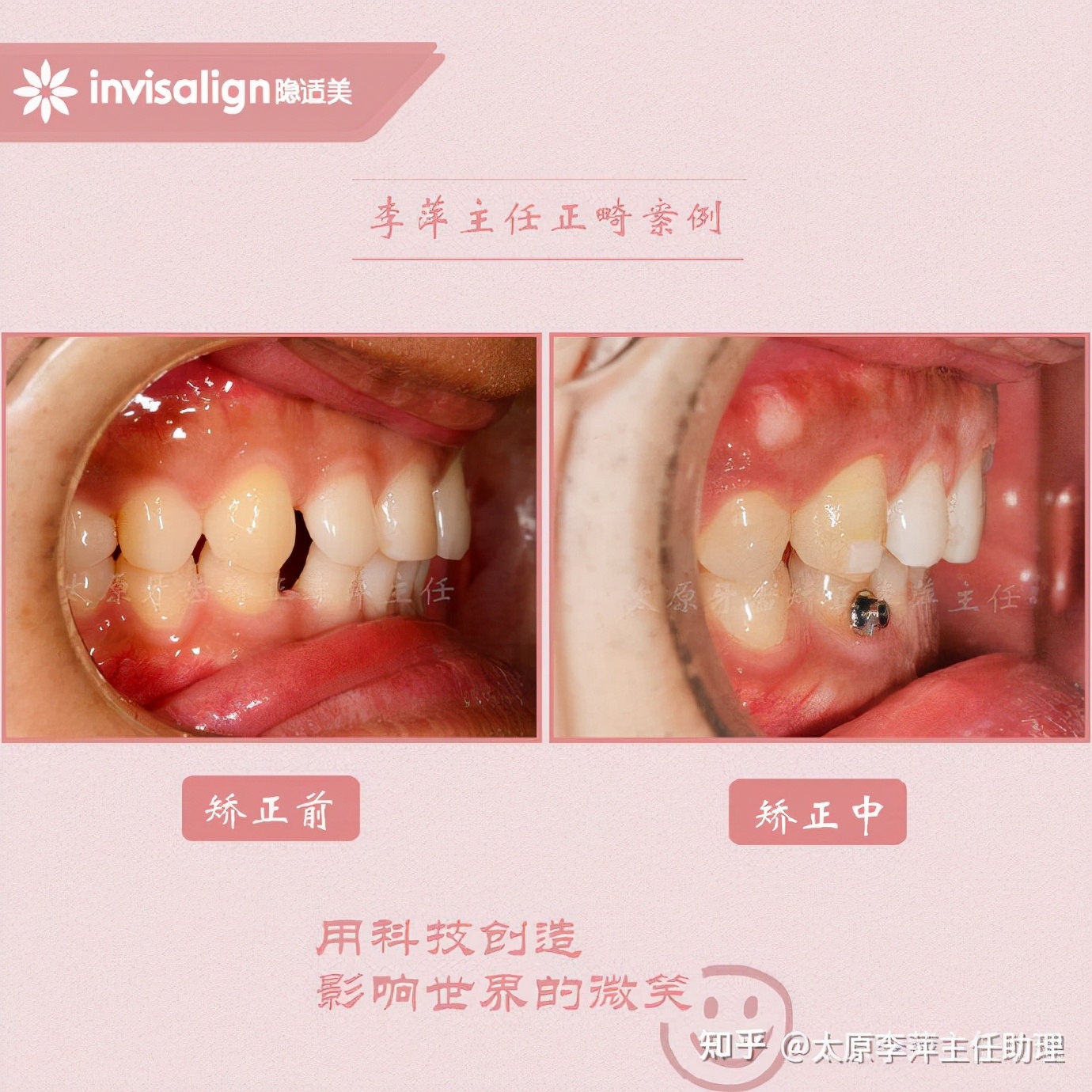 太原牙齿矫正：隐形牙套效果好不好？看这些病例你就知道了