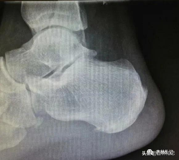 足底疼痛怎么办？找准原因是关键！